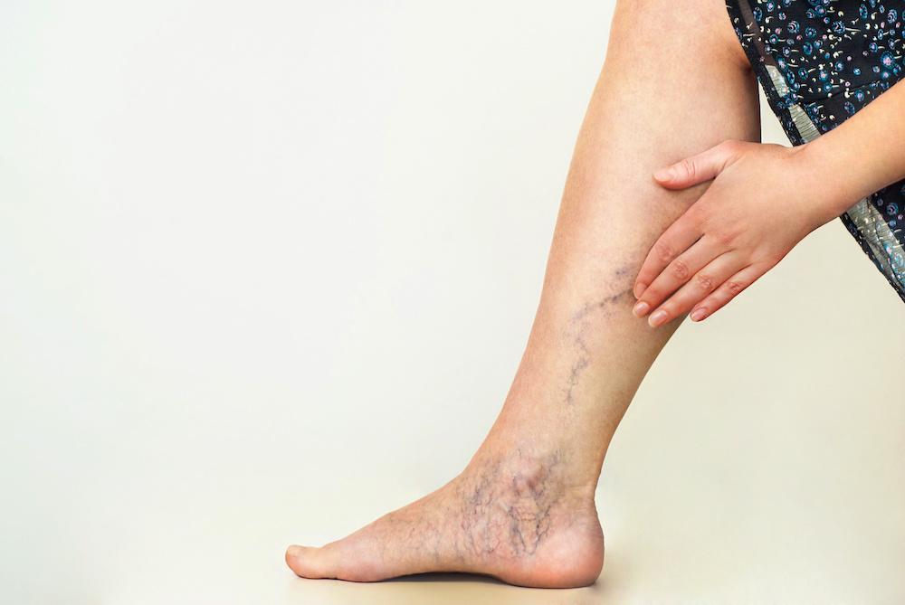 The Importance Of Vascular Health In Preventing Varicose Veins